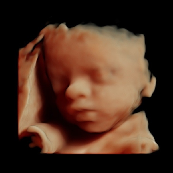 Fetus 27 weeks Fetus 27 weeks